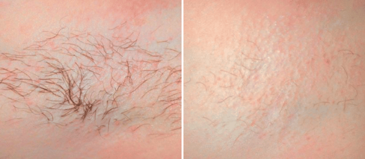 I regret my laser hair removal discount